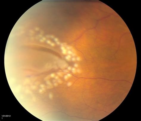 If a retinal tear is detected early, treatment can prevent the retina from detaching. Case 3: Diagnosis & Conclusions