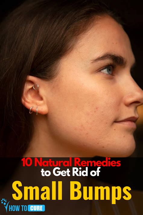 10 Natural Remedies To Get Rid Of Small Bumps On Face In 2020 Small