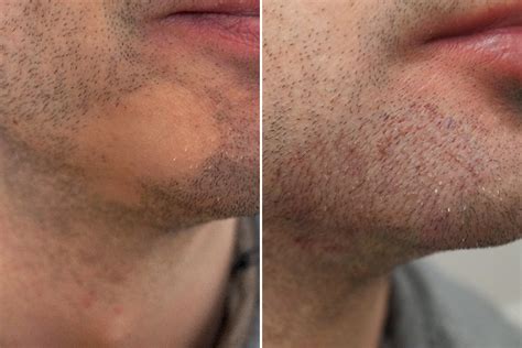 Auszug Lippe Komponente Bart Haartransplantation Wann Rasieren