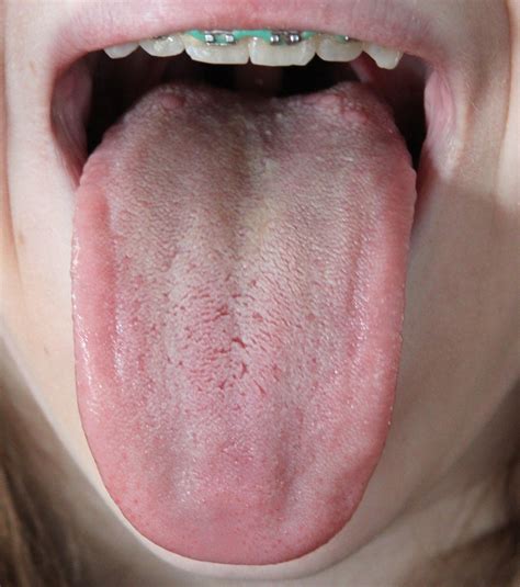 All Images Photos Of White Patches On Tongue Full Hd K K