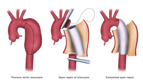 Open Aortic Surgery For Aneurysms Dr Ahmed Farah Abdulrahman
