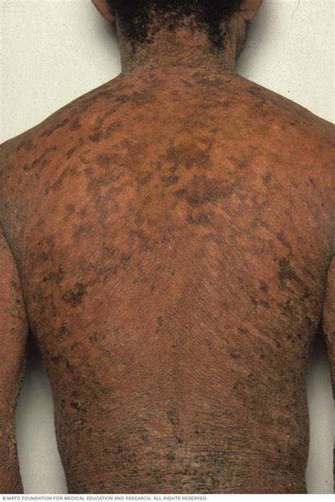 Ichthyosis Vulgaris Symptoms And Causes Mayo Clinic