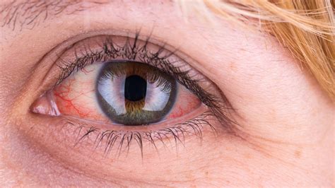 Reasons For Red Eyes With Symptoms Treatment Daayri