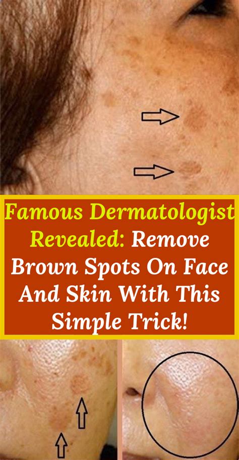 Remove Brown Spots With These Homemade Treatments Wellness Today
