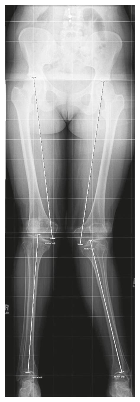 Radiographs Of Lower Extremity Genu Valgus A At Age 22 Ten Years