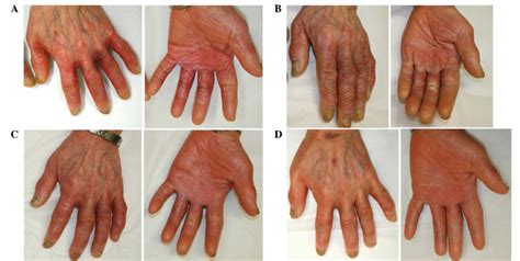 Tumeric Prevents Chemotherapy Induced Hand Foot Syndrome