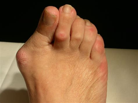 Bunion Surgery The Foot And Ankle Clinic