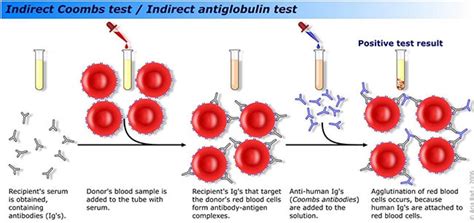 Sometimes referred to as the coombs test) continues to be one of the most widely used assays in laboratory medicine. Coombs Test- Principle, Types, Procedure and Result ...