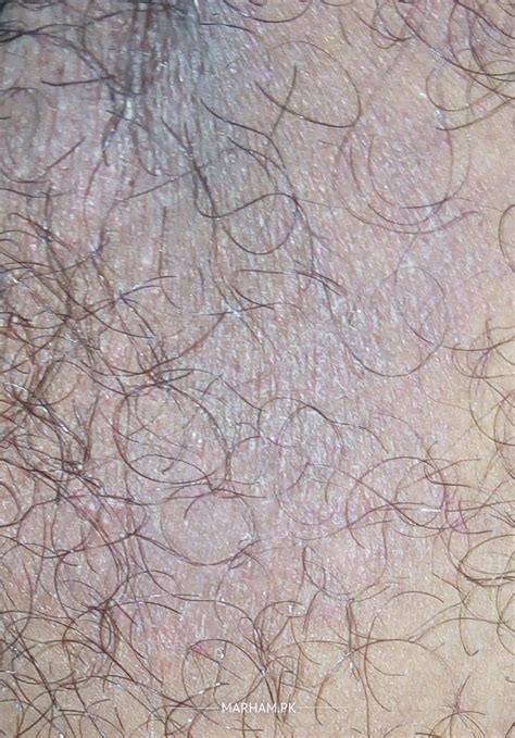 Ask A Dermatologist Online For Rashes On Inner Thighs