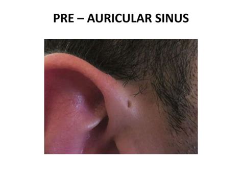 Diseases Of External Ear 1
