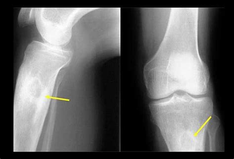 Osteomielita Cauze Simptome Diagnostic Si Tratament Abstract