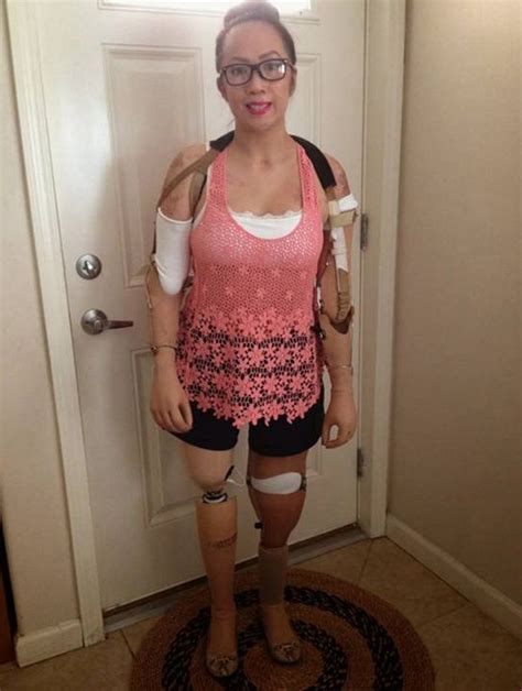 Meet The Human Mannequin Brave Woman Who Lost Limbs To Meningitis Is Now Per Cent Plastic