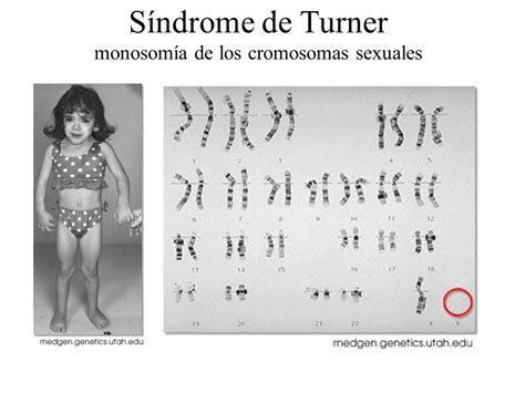 Sindrome De Turner Qu Es El S Ndrome De Turner
