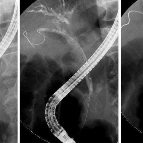A Bile Duct Plastic Stent Migrated Into The Bile Duct A Download