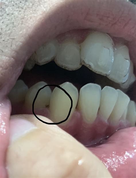 Black Stains On Teeth Near Gums Teethwalls 9da