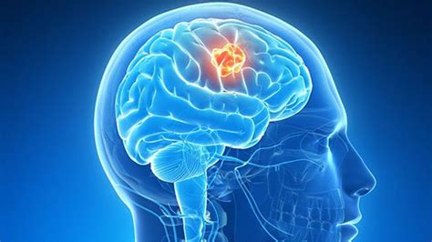 Brain Tumor Symptoms Signs Treatment Surgery Types Orange Health