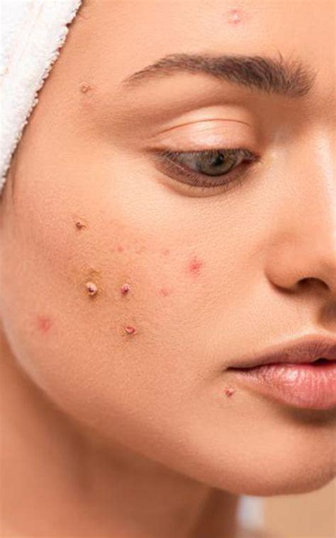 Understanding Acne Causes Types And Treatments Revitalis