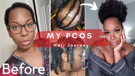 My Pcos Journey Hair Loss Balding And Regrowth Detailed Timeline