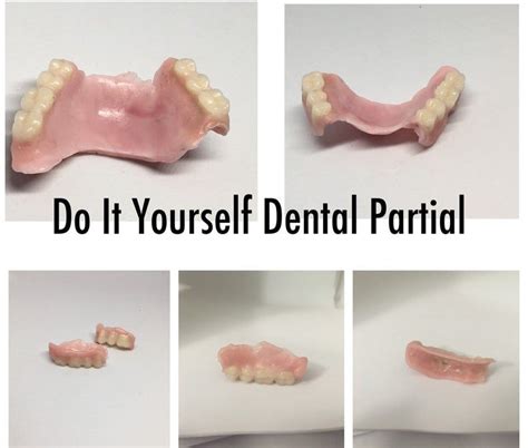 Veneers are a quick and effective solution to stained, chipped, misshapen or crooked teeth. Do It Yourself Denture Kit Make Your Own Temporary Denture/Dental Partial Full Set of Acrylic ...