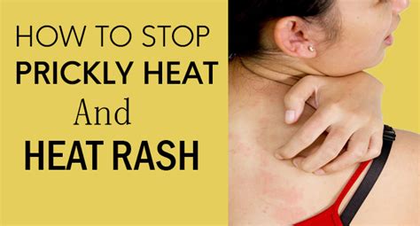 How To Stop Prickly Heat And Heat Rash Remedies Lore