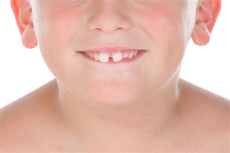 If you have a 2 mm spacing on. Does your child have front teeth gaps? | Smilefocus ...