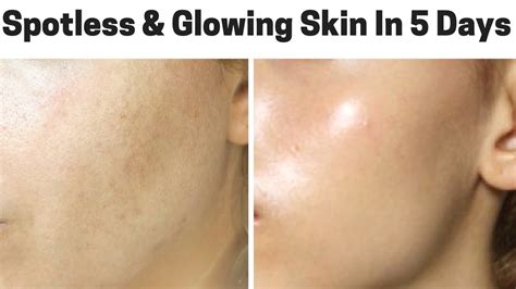 How To Get Spotless Crystal Clear And Glowing Skin In Just 5 Days