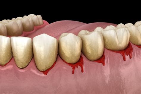 Bleeding Gums And The Stages Of Gum Disease Maitland Square Dentistry