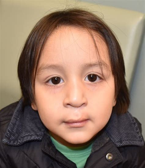 Cleft Lip And Palate Repair Before And After Photos By Rachel Ruotolo