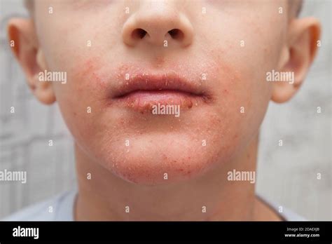 Atopic Skin On The Boy Face Human Skin Presenting An Allergic