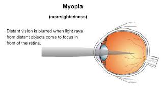 Mengenal Gejala Mata Miopi Tips Pola Hidup Sehat Yang Benar