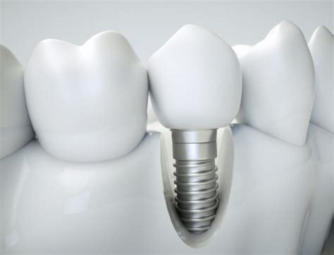 Single Tooth Dental Implants Thurloe Street Dental And Implant Centre