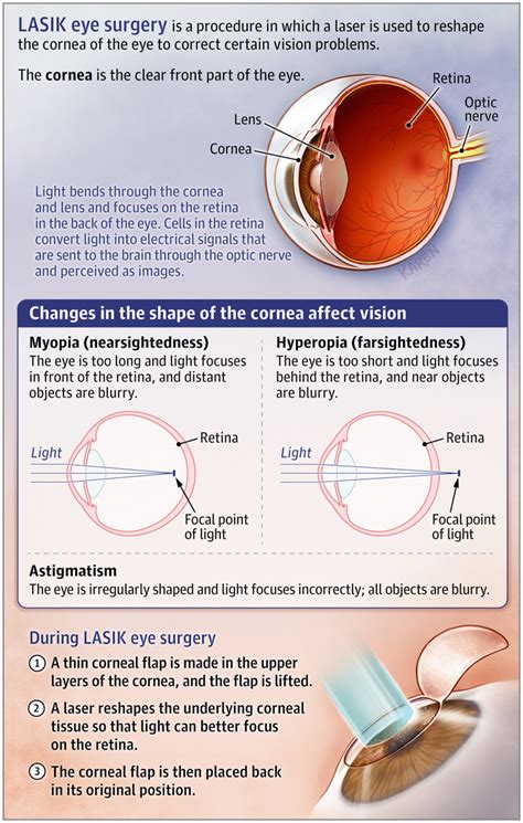 What Is Lasik Eye Surgery In 2020 Lasik Eye Surgery Eye Surgery Lasik