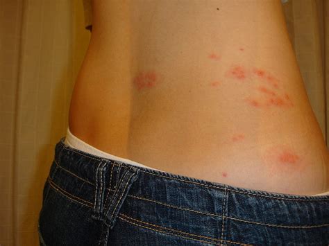 Lower Back Rash Pictures Wjoy