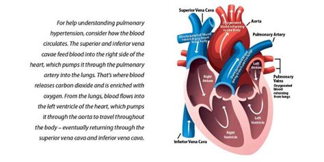 Pulmonary Hypertension Whats Up At Upstate Suny Upstate