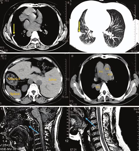 Ct And Mri Scan Of The Patient A And B A Nodule Was Found By Chest