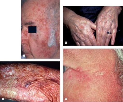 Precancerous And Malignant Skin Conditions Actinic Keratosis Bcc Scc