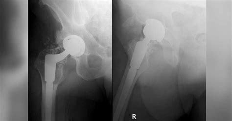 68 Year Old Man With Right Hip Pain Inability To Bear Weight After A