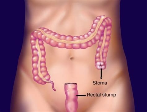 Sigmoid Colectomy Colectomy Colostomy Ostomy