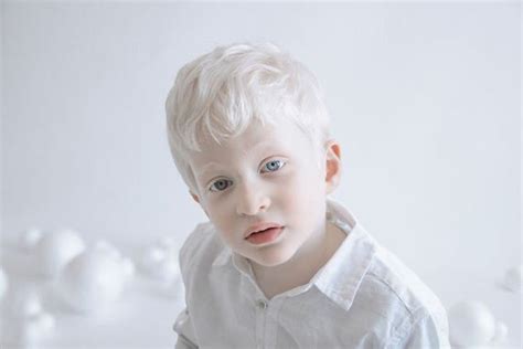 beauty  albinism barnorama