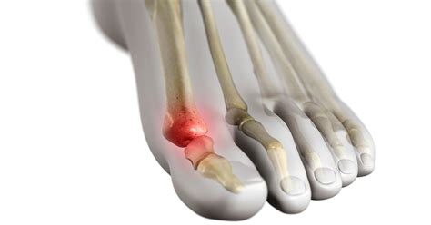 Turf Toe Injury Metatarsophalangeal Joint Sprain