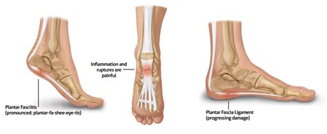 How To Get Rid Of Plantar Fasciitis Tom Corson Knowles