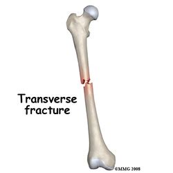 Transverse Fracture All About Fractures