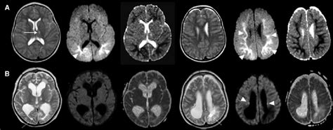 Brain Mri Of The Index Patient At The Ages Of 8 And 125 Years From