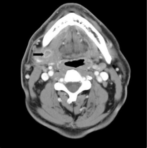 Ct Scan Of The Neck With Contrast Showing A Ring Enhancing Lesion On Download Scientific