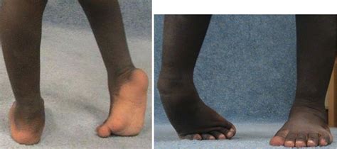 Equinovarus Foot Deformity In Cerebral Palsy Springerlink