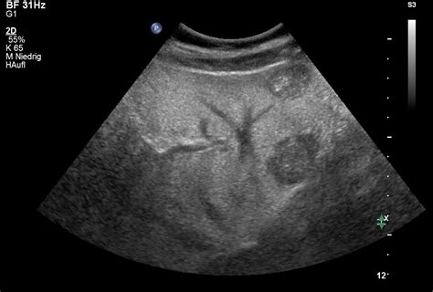 Liver Nodule Ultrasound