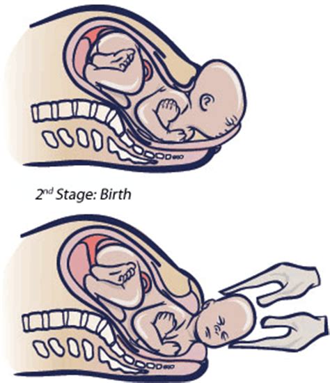 Posted on june 6, 2019. Second-stage Labour begins with full dilation and ends ...