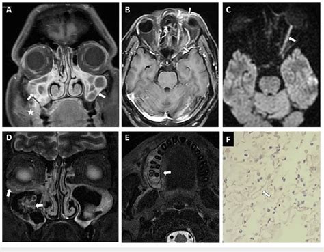 Case Of Mucormycosis In A Post Covid Patient Having Sinonasal And