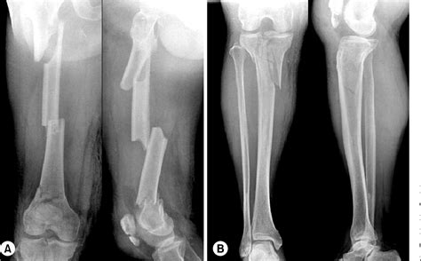 Figure 1 From Ipsilateral Femoral Segmental And Tibial Fractures − A