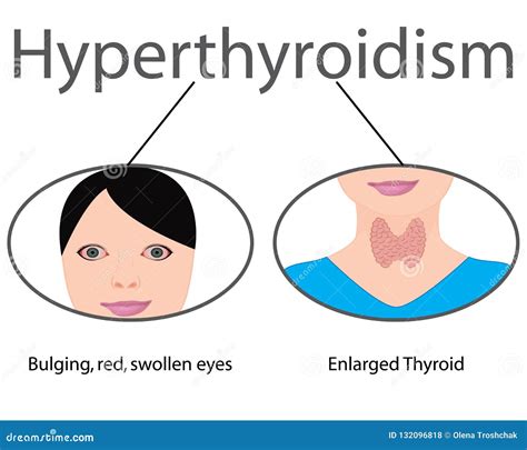 Hyperthyroidism Enlarged Thyroid Endocrine Disfunction Vector Illustration Stock Vector
